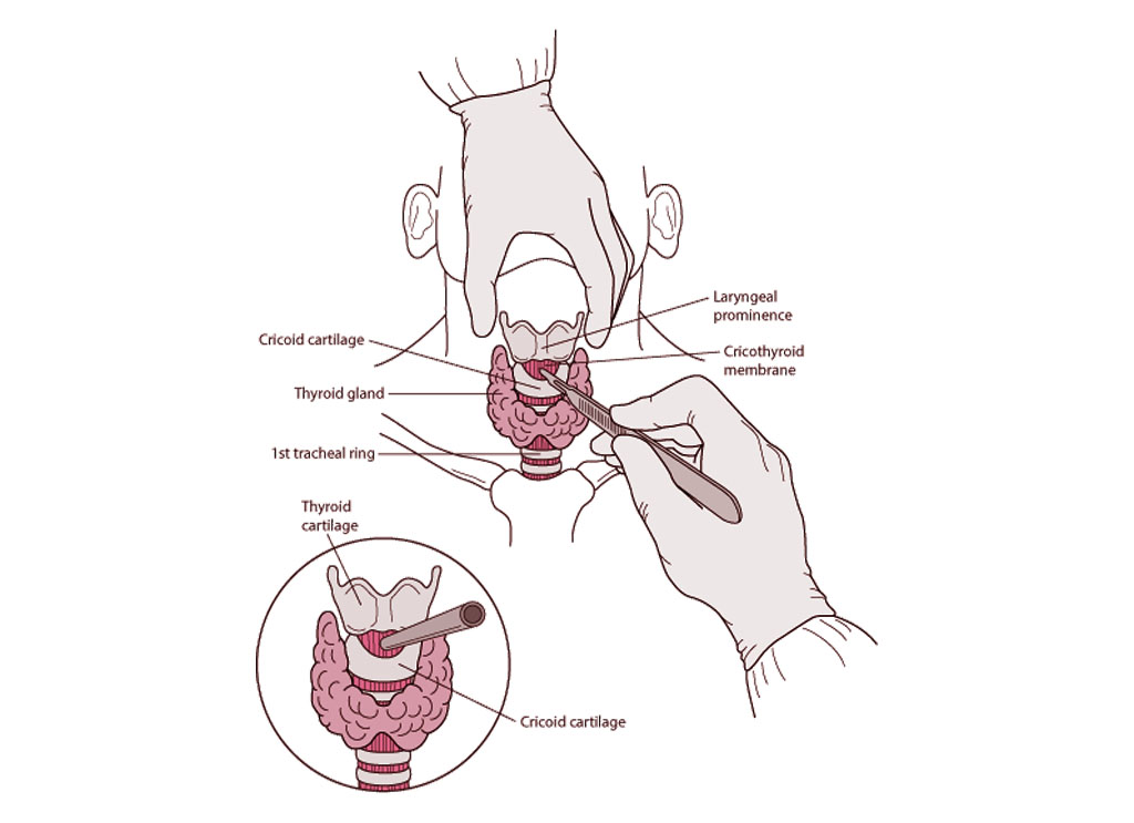 Cricothyrotomy procedure